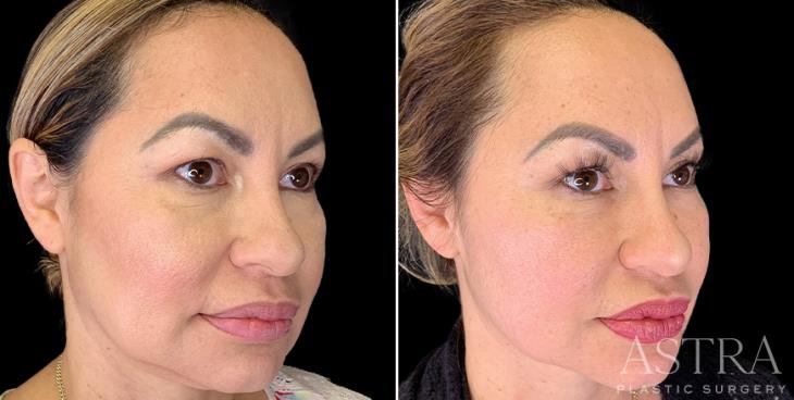 Before And After Dermal Fillers Atlanta