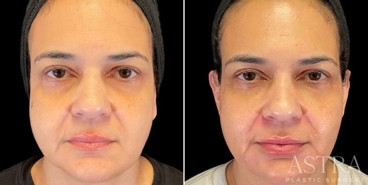 Before And After Dermal Fillers Atlanta GA