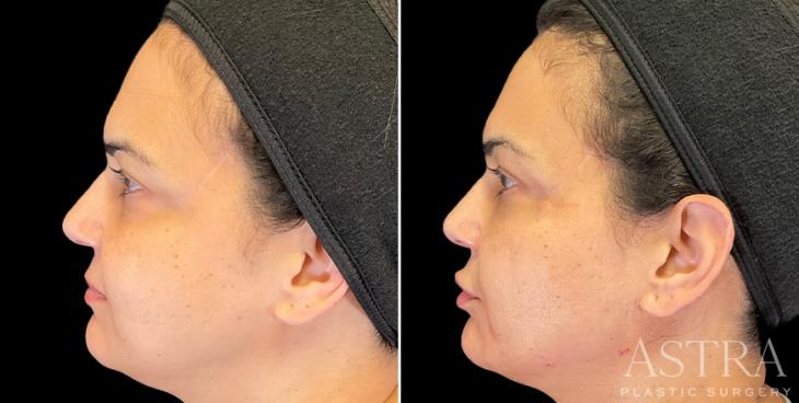 Atlanta GA Before And After Dermal Fillers