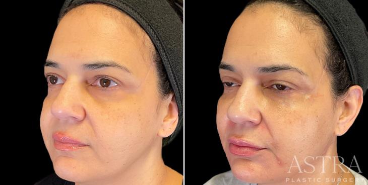 Before And After Dermal Fillers Atlanta Georgia