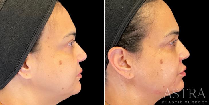 Before And After Dermal Fillers GA