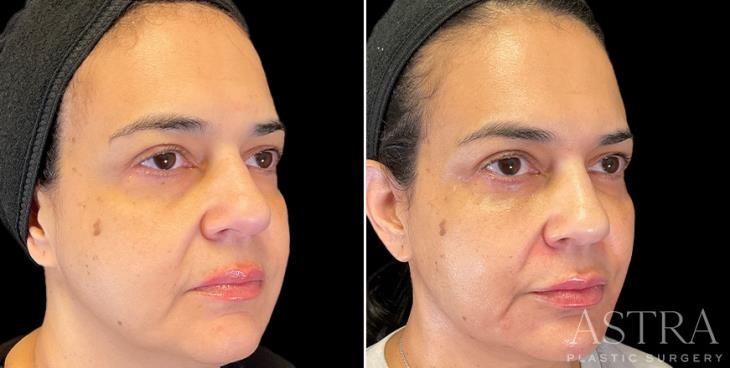 Atlanta Georgia Before And After Dermal Fillers