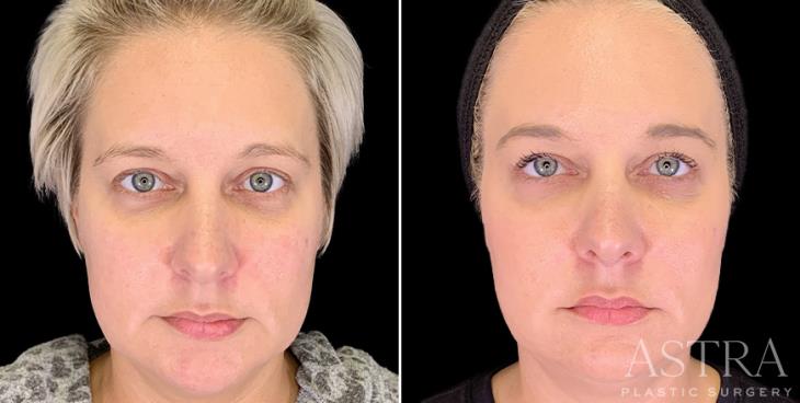 Before And After Dermal Fillers Georgia