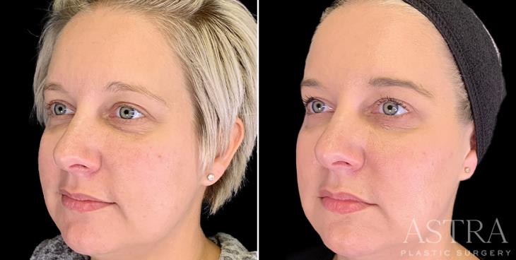 Georgia Before And After Dermal Fillers