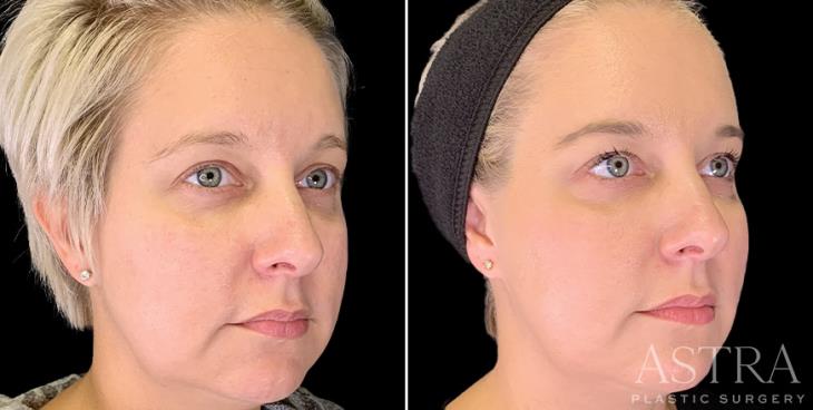 Before And After Dermal Fillers Atlanta Georgia