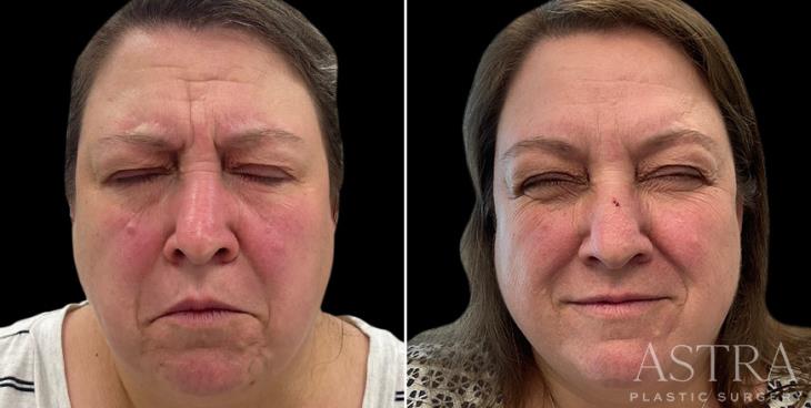 Results Of Botox Cosmetic