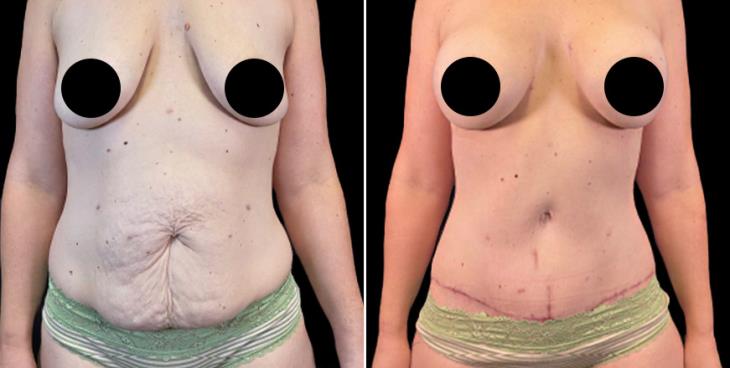 Tummy Tuck Before and After