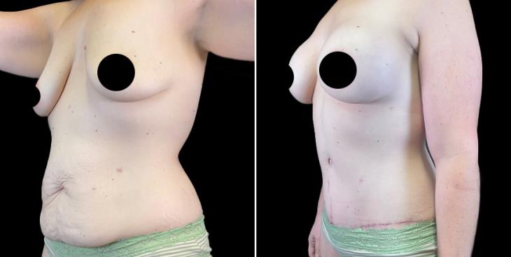 GA Before & After Abdominoplasty