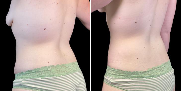 Before & After Abdominoplasty GA