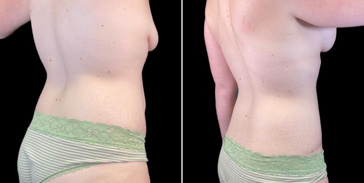 Before And After Abdominoplasty GA
