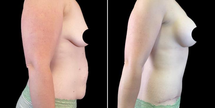 Before And After GA Abdominoplasty