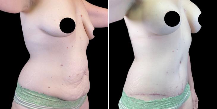GA Before And After Abdominoplasty