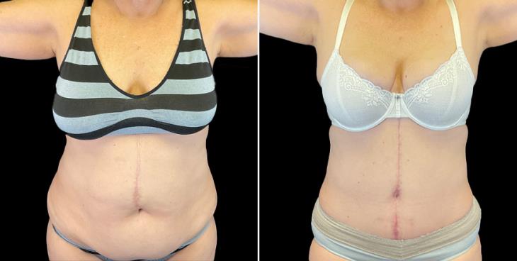 Tummy Tuck Results Front View GA