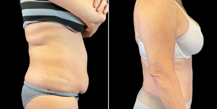 Tummy Tuck Before & After GA