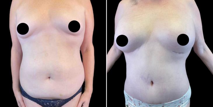 Tummy Tuck Results Marietta