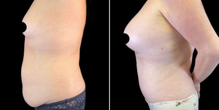 Marietta Tummy Tuck Results