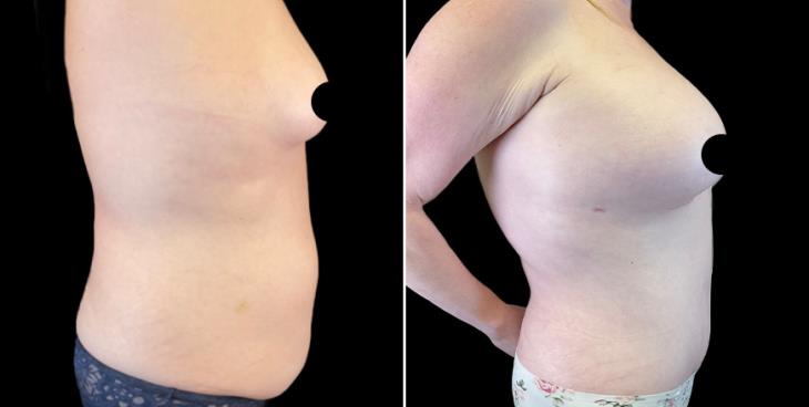 Marietta Tummy Tuck Results Side View
