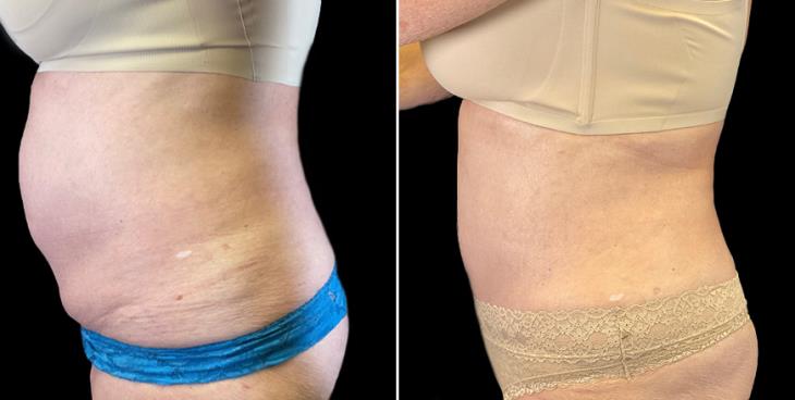 Side View Tummy Tuck Results Marietta