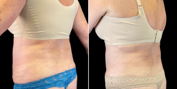 Tummy Tuck Results Marietta ¾ View