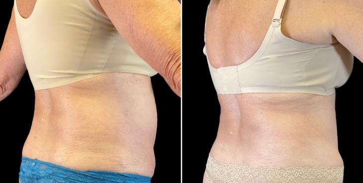 ¾ View Tummy Tuck Results Marietta