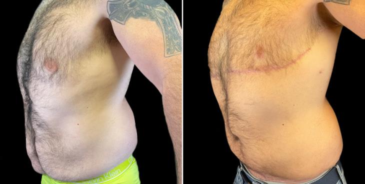 Results Of Male Tummy Tuck