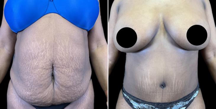 Tummy Tuck Marietta GA