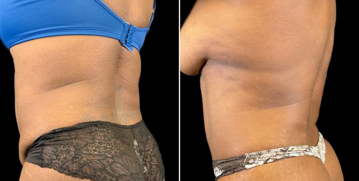 Tummy Tuck Marietta GA ¾ View