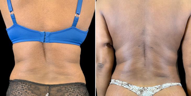 Atlanta Tummy Tuck Results Back View