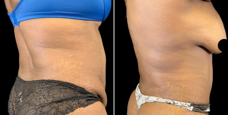 Side View Tummy Tuck Marietta GA