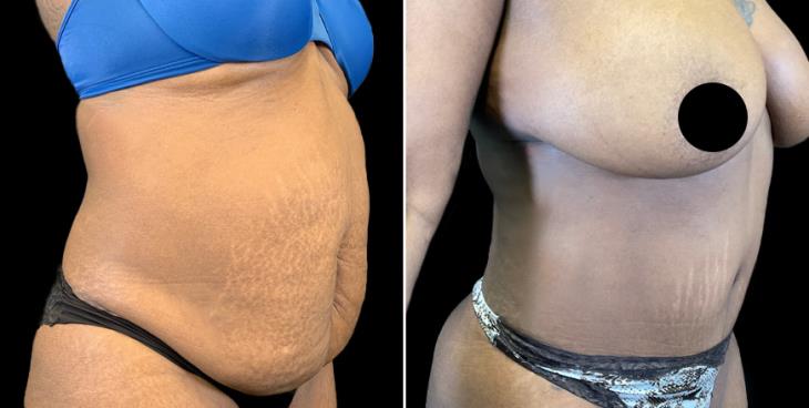 Before & After Tummy Tuck Marietta