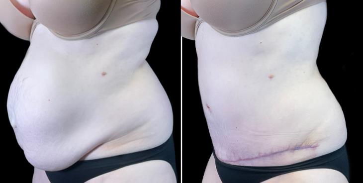 Before And After Tummy Tuck Marietta