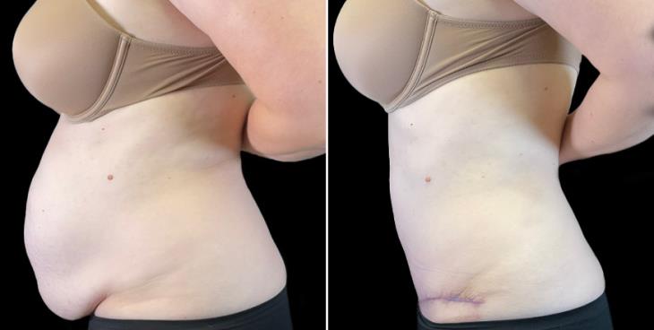 Before & After Tummy Tuck Marietta