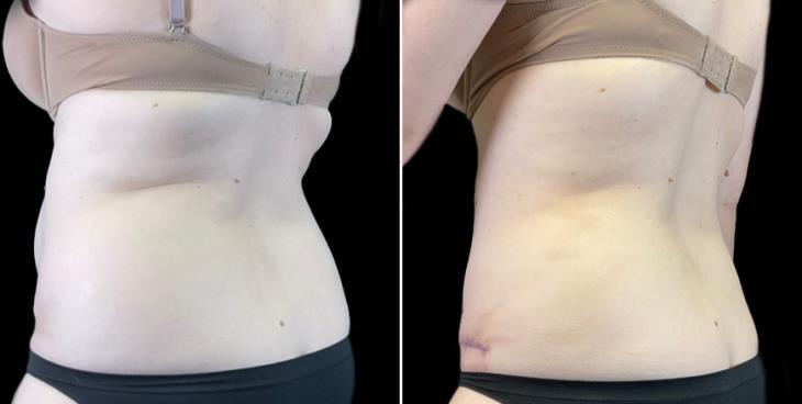 Tummy Tuck Before And After Marietta
