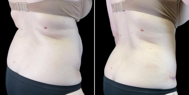 Marietta Tummy Tuck Before And After