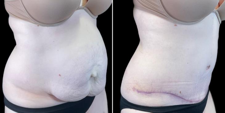 Marietta Before And After Tummy Tuck