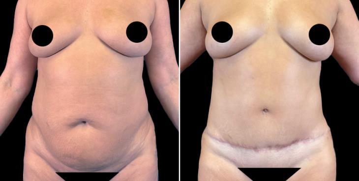 Marietta Abdominoplasty Results