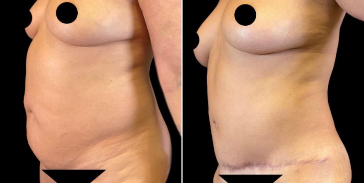 Marietta Results Of Abdominoplasty