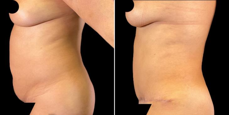 Results Of Abdominoplasty In Marietta