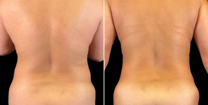 Abdominoplasty Results Marietta