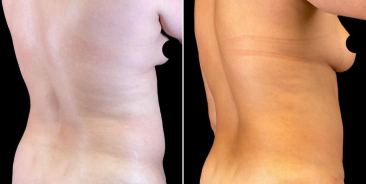 Abdominoplasty Results Marietta GA