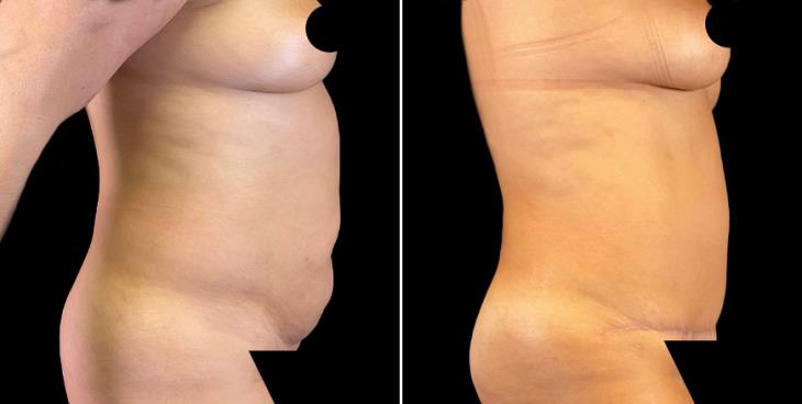 Results Of Abdominoplasty Marietta GA