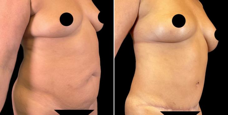 Marietta GA Abdominoplasty Results