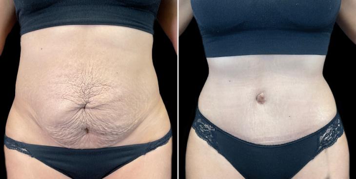 Marietta GA Results Of Abdominoplasty