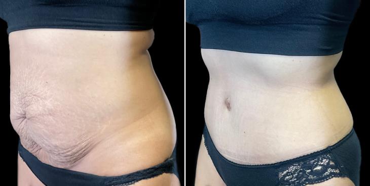 Marietta Tummy Tuck