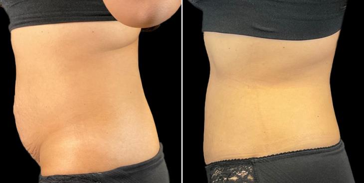 Tummy Tuck Marietta