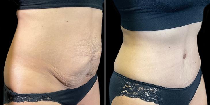 Tummy Tuck Marietta GA