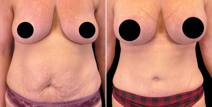 Marietta GA Tummy Tuck