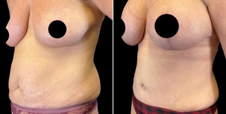 Abdominoplasty Marietta