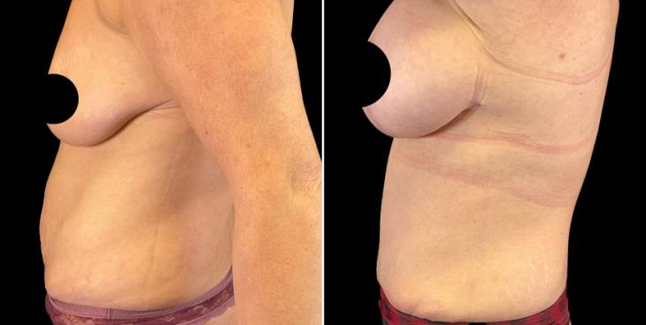 Marietta Abdominoplasty