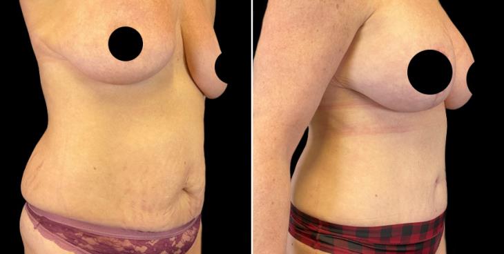 Marietta GA Abdominoplasty